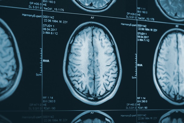 A close-up view of multiple clinical MRI brain scans on a dark monitor, showing detailed cross-sections used to evaluate traumatic injuries. (217769387)